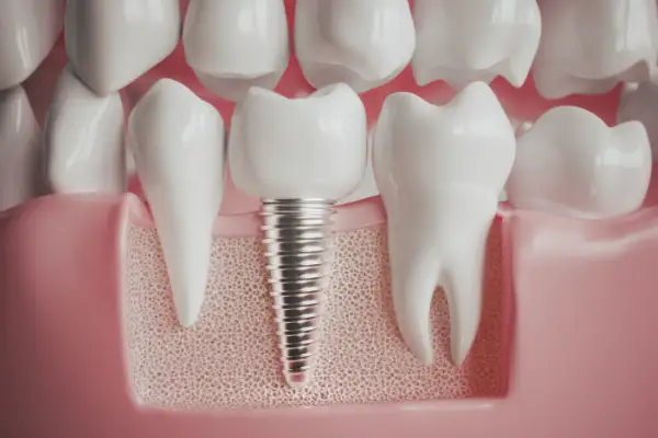 implantaty zubne